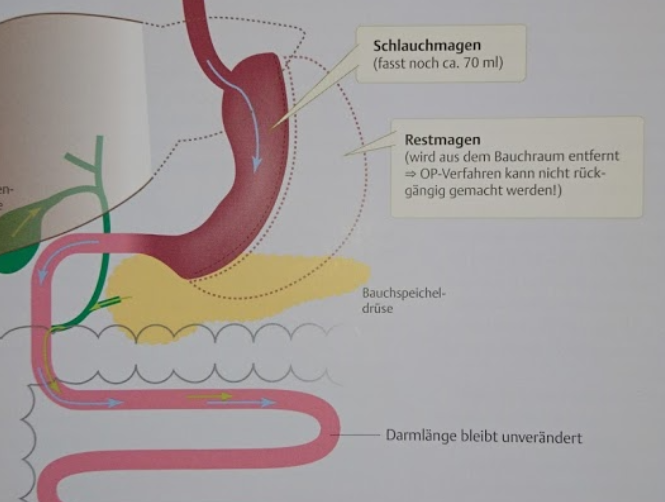 Schlauchmagen Operation